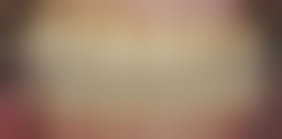 하악 전악 · 상악 어금니 임플란트 – 치료 후